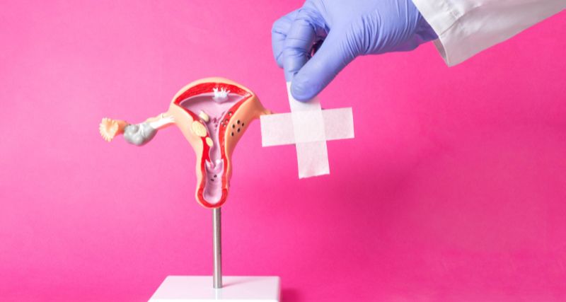 ISEIE-Master en estudios para Endometriosis, Maestría en Endometriosis